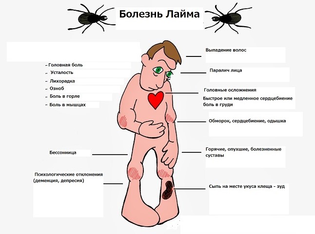 Болезнь Лайма