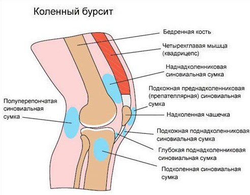 Бурсит