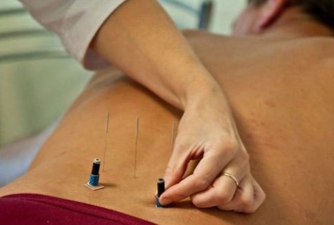 Рефлексотерапия при защемлении седалищного нерва