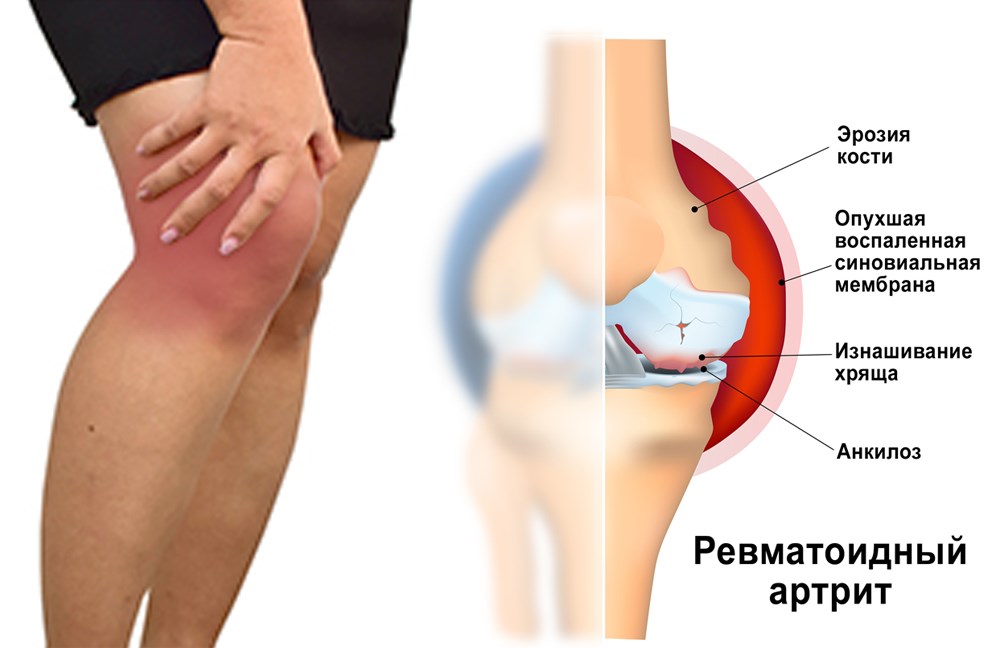 Ревматоидный артрит