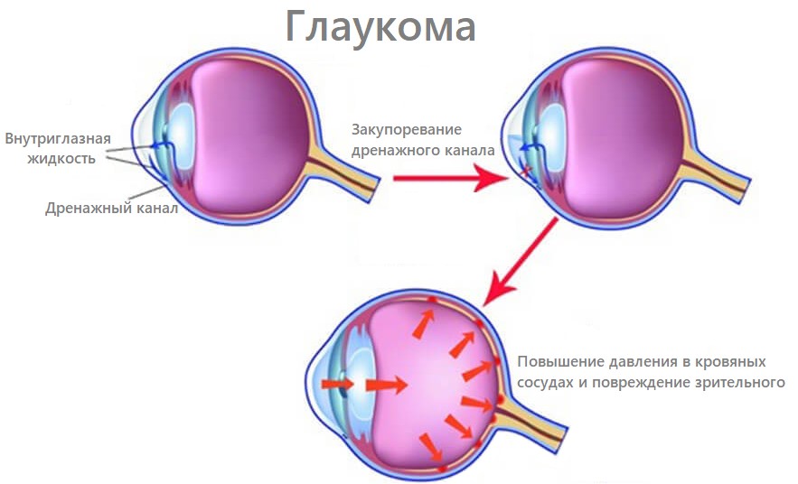Глаукома причины заболевания